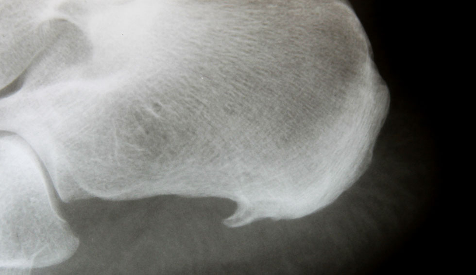Röntgenaufnahme eines Fersensporns